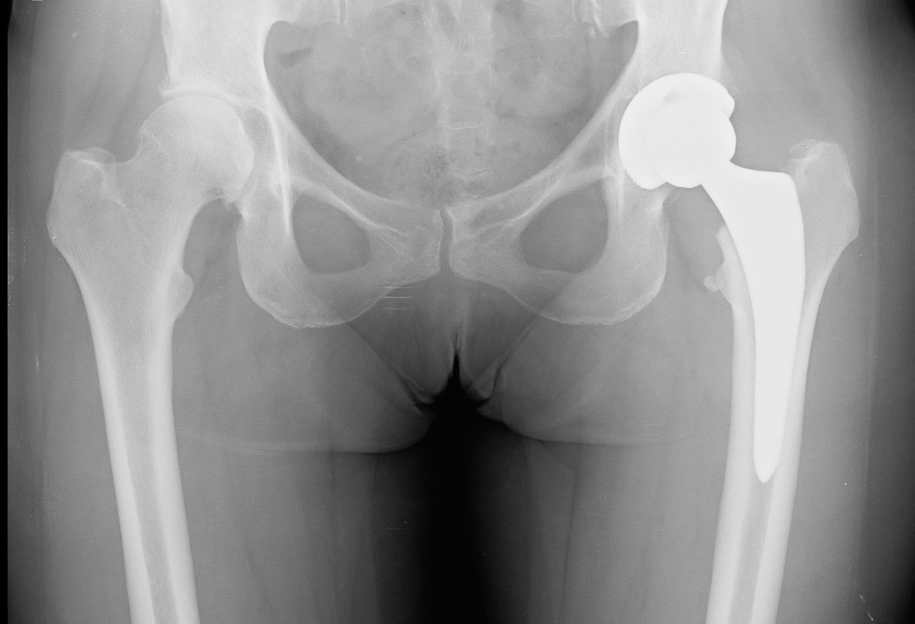 Hip Replacement Surgery (Total Hip Arthroplasty) - Schulze Orthopedics